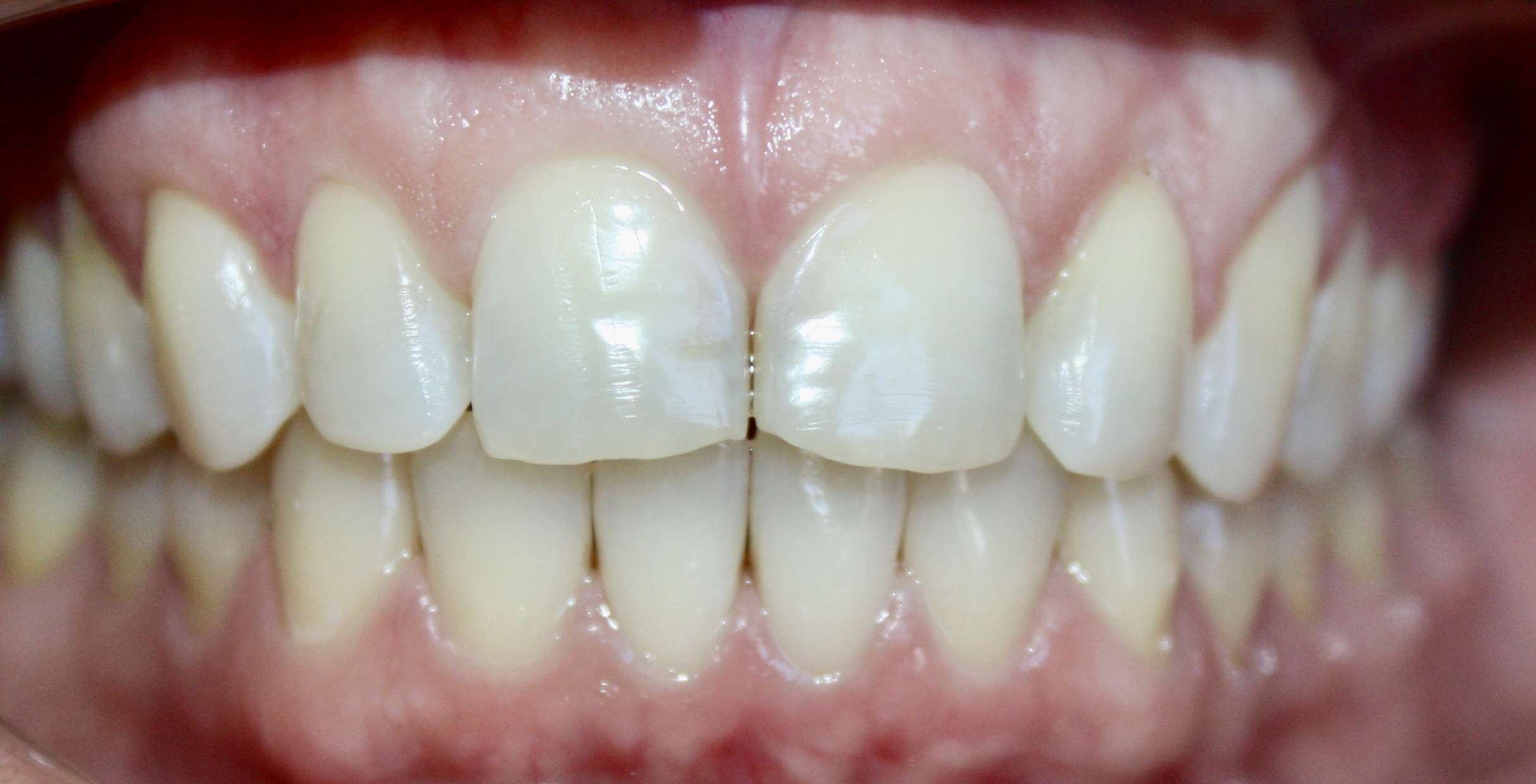 Crowded teeth aligned after